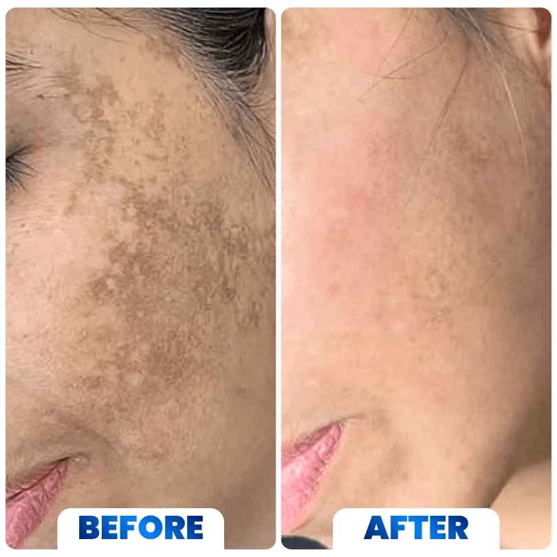 Advanced Brightening & Dark Spot Eraser Cream